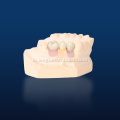 ຮູບແບບການຟື້ນຟູ Implant 3D ທີ່ພິມອອກ